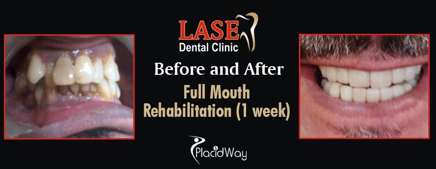 Before and After Dental Rehabilitation in Mumbai, India
